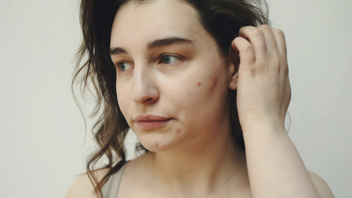 Effective Acne Care in Dunn Loring, VA